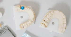 Plaster dental models of upper and lower teeth with one tooth marked in blue for a custom crown and bridge fit