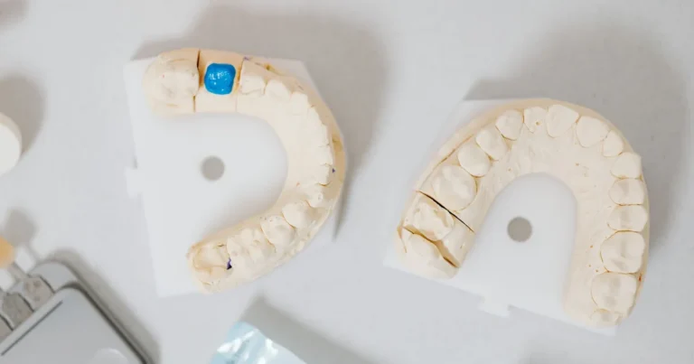 Plaster dental models of upper and lower teeth with one tooth marked in blue for a custom crown and bridge fit