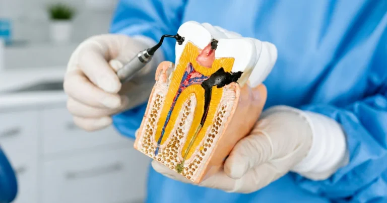Root Canal Therapy: What You Need to Know About Treatment